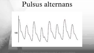 Pulsus alternans [upl. by Erastatus]