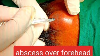 abscess over forehead  infected cyst over forehead  incision n drainage youtube dr doctor [upl. by Leggat]