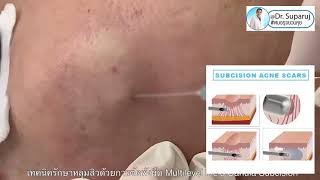 รักษาหลุมสิวด้วยเทคนิคการตัดพังผืด Subcision Multilevel Field Cannula Subcision หมอรุจชวนคุย [upl. by Penny595]