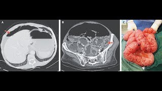 Pneumatosis intestinales mit Pneumoperitoneum [upl. by Yenttihw567]