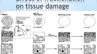 La radiothérapie pour les tumours cérébrales [upl. by Llednew949]