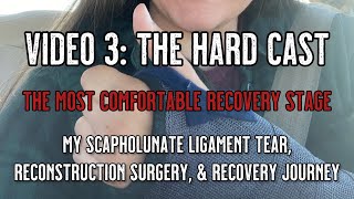 Scapholunate Ligament Tear and Reconstruction  Video 3 hard cast update [upl. by Whelan]