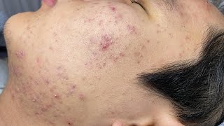 ACNE TREATMENT VU QUYNH MI  Blackheads Of Tweens 2024 EX [upl. by Dowell861]