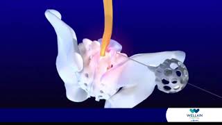 Minimally Invasive Spine Surgery [upl. by Carolyn]