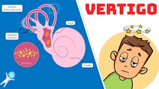 Vertigo from BPPV  Causes Symptoms and Treatment [upl. by Sparkie]