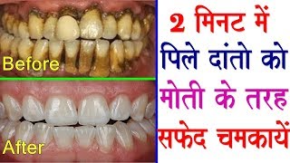 This remedy will brighten yellow dirty teeth like pearls  Teeth Whitening Home Remedies [upl. by Ynffit79]