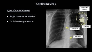 How to Interpret a Chest XRay Lesson 9  Atelectasis Lines Tubes Devices and Surgeries [upl. by Thamora]