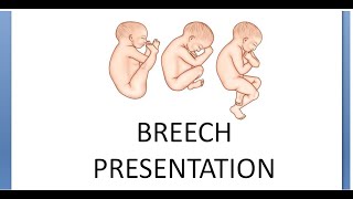 Obstetrics 456 a Breech Presentation What is Definition Types Frank Complete Incomplete Flexed [upl. by Aniaz]