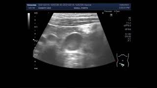 Mesenteric lymphadenitis [upl. by Yve]