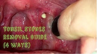 How to Remove Tonsil Stones Tonsillitis at Home [upl. by Ferrick]