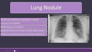 Chest Xray with Lung Nodules and Bronchiectasis radiology [upl. by Feltie]