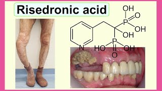 risedronic acid [upl. by Wivinah]