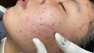 ACNE TREATMENT VU QUYNH MI  Blackheads Of Tweens 2024 EX [upl. by Asilla]