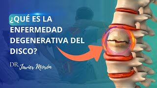 ¿Qué es la enfermedad degenerativa del disco lumbar  Pérdida de altura del disco intervertebral [upl. by Hadria]