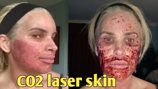 7Day Journey My CO2 Laser Skin Resurfacing Experience – Before and after chris link [upl. by Darryl565]