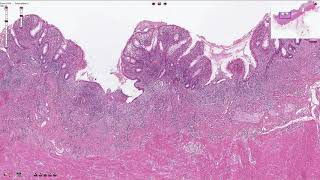 Ulcerative Colitis  Histopathology [upl. by Sellma]