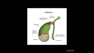 Gallstones [upl. by Mahgem]