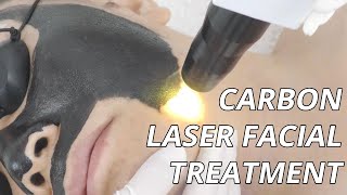 Can This Carbon Laser Facial Treat Melasma Carbon Laser Peel How It Works [upl. by Koziara]