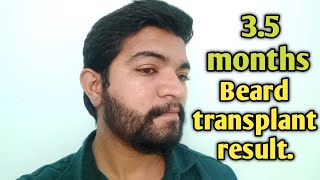 Beard transplant results 35 months  Tamil [upl. by Westhead673]