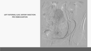 Preoperative sacral tumor embolisation [upl. by Akeyla791]