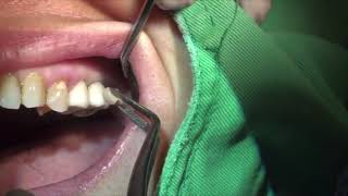 Veneer Removal and Periodontal Treatment with LIGHTMEDs SAPPHIRE Laser [upl. by Adnilem]