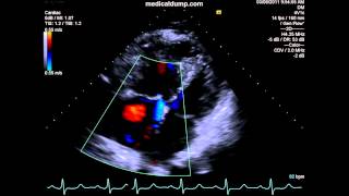 Severe Pulmonary HTN  Pulmonary Regurgitation  TTE [upl. by Zia]