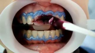 Using FGM Whiteness HP Maxx For In Office Bleaching Tooth Whitening [upl. by Gosselin]