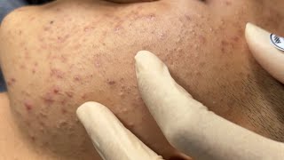 Blackheads amp Whiteheads Removal New 2024  Acne Treatment With Bo Nguyễn Spa 007 [upl. by Chico]