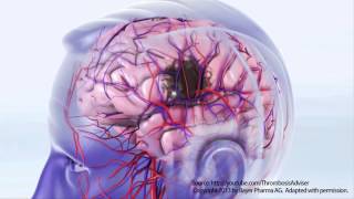 AFIB and StrokeMicrolife [upl. by Follmer]