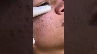 Deep skin cleaning session with black heads [upl. by Kurtz]