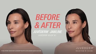 A Smooth Contour In The Jawline With JUVÉDERM® Filler  Lara’s Before amp After [upl. by Gorlin]