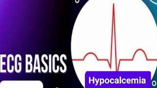 ECG Basics  ECG changes in  Hypocalcemia  causes and symptoms of Hypocalcemia [upl. by Irodim]