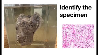 Pathology specimen Renal Cell Carcinoma [upl. by Rolf]