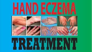 DyshidrosisDyshidrotic eczemaHand eczemaPompholyx treatment [upl. by Cyprian]