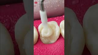 Unbelievable Tooth Restoration asmr restoration [upl. by Atinihc432]