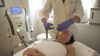 IPL Photofacial with Lumenis M22 at Trifecta Med Spa [upl. by Anerrol650]