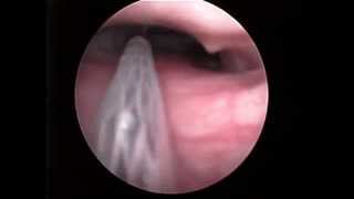 Stent and tracheoscopy in dog [upl. by Bax]