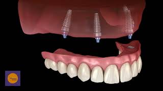 PROTESI FISSA SUPERIORE SU 4 IMPIANTI [upl. by Arayk]