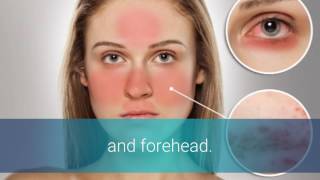 Rosacea Types [upl. by Cottle641]