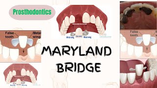 Maryland bridgeprosthodonticsshortnotes exams question dentalstudies importantquestions study [upl. by Tamberg]