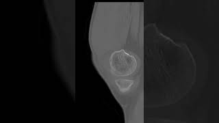 PCL avulsion Tibia Fracture [upl. by Ashraf]