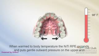 NiTi Palatal Expander  Orthodontics [upl. by Caitrin]