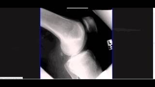 Interpreting XRays of the Knee Joint [upl. by Hagood]