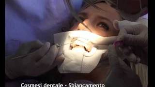 Cosmesi dentale Sbiancamento [upl. by Hersh]