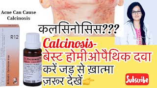 Calcinosis कल्सिनोसिसकलसियम का ज़्यादा होनाHomeopathyBest Treatment By DrRukmani Choudhary [upl. by Pish288]