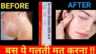 tacroz ointment use in hindi  tacrolimus ointment [upl. by Sinnel300]