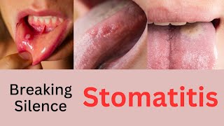 Breaking the Silence on Stomatitis  Understanding Stomatitis Causes Symptoms and Treatment [upl. by Wilkison]