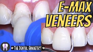 EMAX Porcelain Veneer HOW Do they DO it C41 4k [upl. by Jehius61]