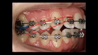 Uso de los elásticos en Ortodoncia Fija [upl. by Gord]