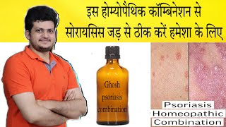 Best Homeopathic Psoriasis Combination  सोरायसिस को हमेशा के लिए ठीक करें  Homeopathic Medicine [upl. by Nnaeitak]